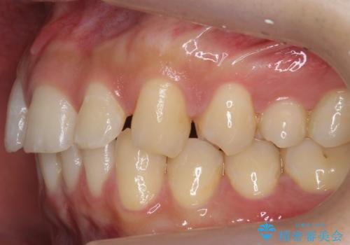 すきっ歯 セラミックで治すか矯正で治すか相談したいの治療前