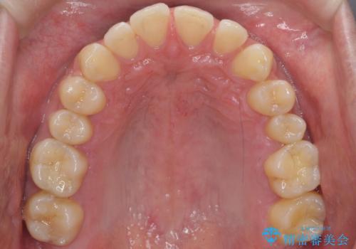 すきっ歯 セラミックで治すか矯正で治すか相談したいの治療前