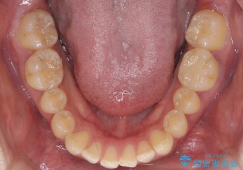 すきっ歯 セラミックで治すか矯正で治すか相談したいの治療前