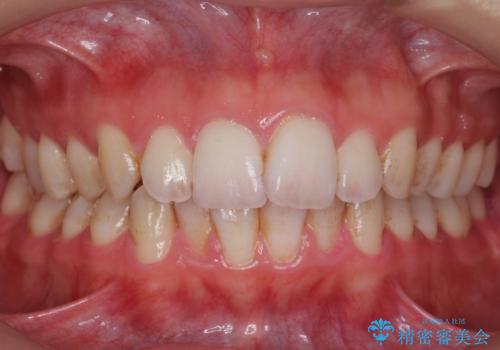 歯の着色を落としたいの症例 治療前