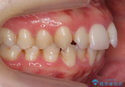 歯の着色を落としたいの治療前