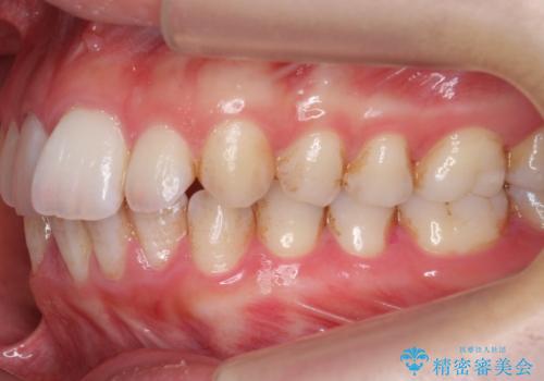 歯の着色を落としたいの治療前