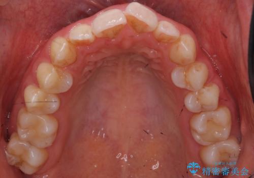 歯の着色を落としたいの治療前