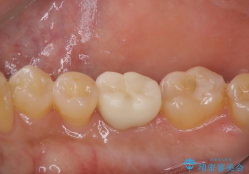 【根管治療】物が当たるだけで痛いの治療後