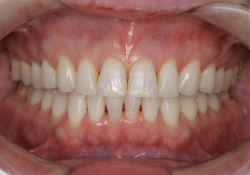 定期健診で歯並びを相談　セラミックブラケットでのワイヤー矯正例の症例 治療後
