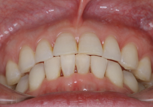 定期健診で歯並びを相談　セラミックブラケットでのワイヤー矯正例の治療後
