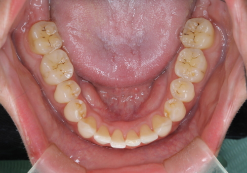 定期健診で歯並びを相談　セラミックブラケットでのワイヤー矯正例の治療後
