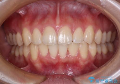 デコボコをワイヤー装置で改善 短期間で綺麗な仕上がりにの治療後