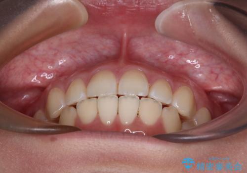 デコボコをワイヤー装置で改善 短期間で綺麗な仕上がりにの治療後