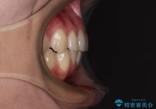 デコボコをワイヤー装置で改善 短期間で綺麗な仕上がりにの治療後