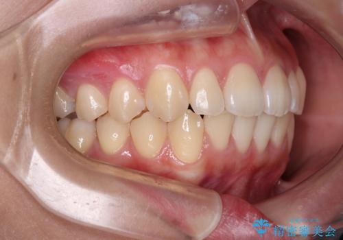 デコボコをワイヤー装置で改善 短期間で綺麗な仕上がりにの治療後