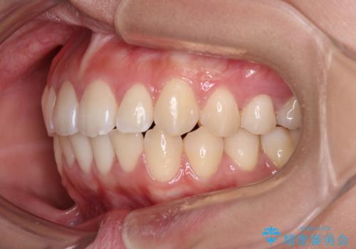 デコボコをワイヤー装置で改善 短期間で綺麗な仕上がりにの治療後