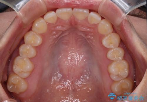 デコボコをワイヤー装置で改善 短期間で綺麗な仕上がりにの治療後