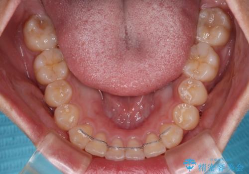 デコボコをワイヤー装置で改善 短期間で綺麗な仕上がりにの治療後