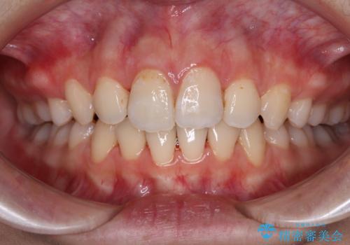 指が入るくらいに隙間のある上下前歯　抜歯矯正で横顔の印象が大きく改善