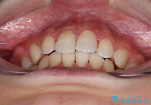 指が入るくらいに隙間のある上下前歯　抜歯矯正で横顔の印象が大きく改善の治療後