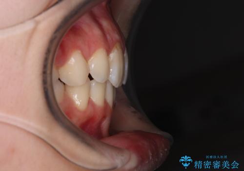 指が入るくらいに隙間のある上下前歯　抜歯矯正で横顔の印象が大きく改善の症例 治療後