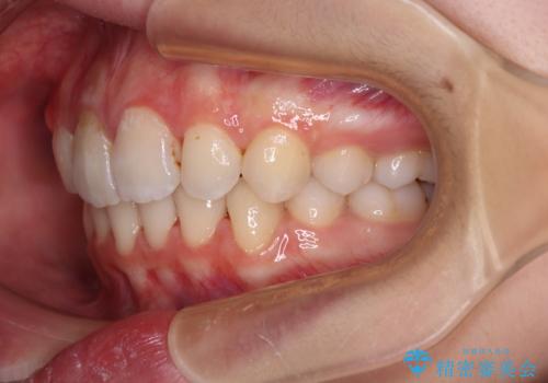 指が入るくらいに隙間のある上下前歯 抜歯矯正で横顔の印象が大きく改善の治療後