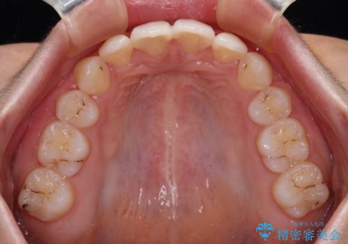 指が入るくらいに隙間のある上下前歯　抜歯矯正で横顔の印象が大きく改善の治療後
