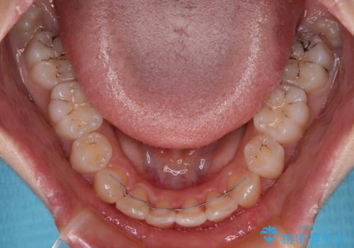 指が入るくらいに隙間のある上下前歯 抜歯矯正で横顔の印象が大きく改善の治療後