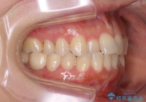 早い安いきれい!インビザラインライトで前歯のでこぼこ、反対咬合をなおすの治療前