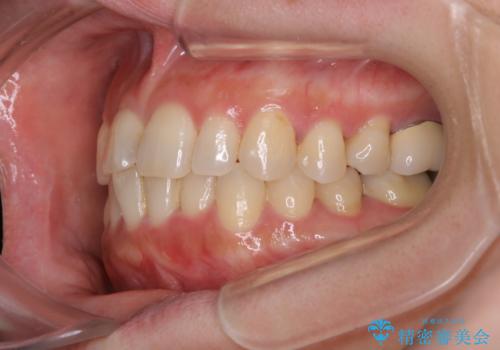 早い安いきれい!インビザラインライトで前歯のでこぼこ、反対咬合をなおすの治療前