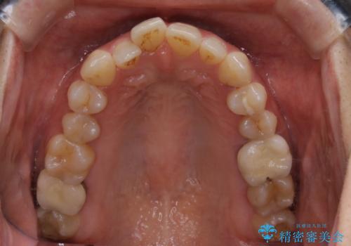 早い安いきれい!インビザラインライトで前歯のでこぼこ、反対咬合をなおすの治療前