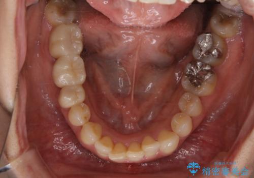 早い安いきれい!インビザラインライトで前歯のでこぼこ、反対咬合をなおすの治療前