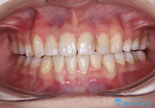 八重歯と正中のズレ　ワイヤー装置での抜歯矯正