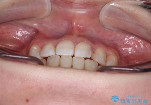 八重歯と正中のズレ ワイヤー装置での抜歯矯正の治療後