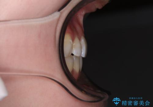 八重歯と正中のズレ ワイヤー装置での抜歯矯正の治療後