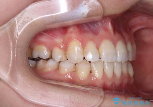 八重歯と正中のズレ ワイヤー装置での抜歯矯正の治療後