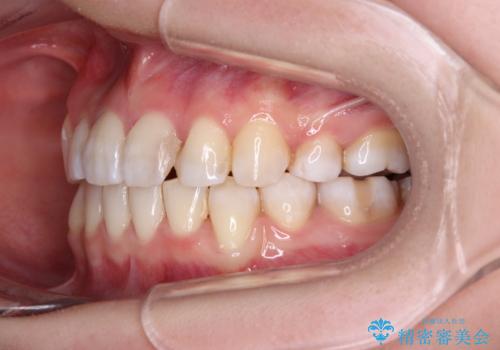 八重歯と正中のズレ ワイヤー装置での抜歯矯正の治療後