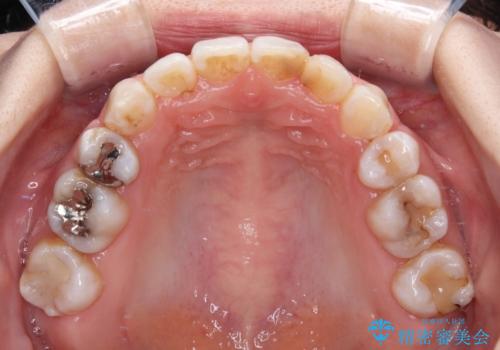 八重歯と正中のズレ ワイヤー装置での抜歯矯正の治療後