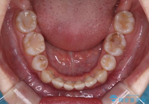 八重歯と正中のズレ ワイヤー装置での抜歯矯正の治療後