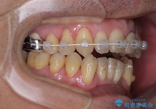 外科手術を検討? 過大な開咬をワイヤー装置とインビザラインで劇的に改善するの治療中