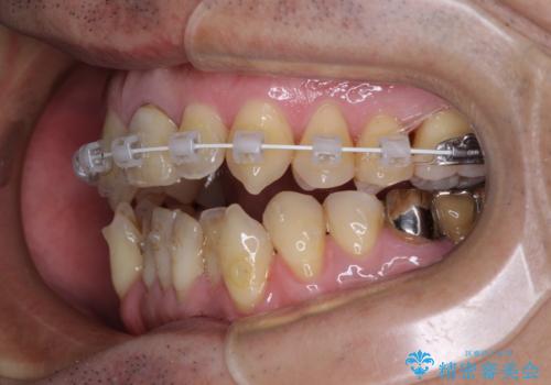 外科手術を検討? 過大な開咬をワイヤー装置とインビザラインで劇的に改善するの治療中