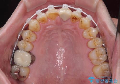 外科手術を検討? 過大な開咬をワイヤー装置とインビザラインで劇的に改善するの治療中