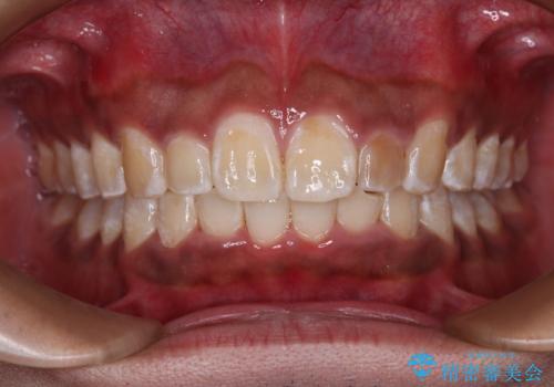 上顎前突とディープバイト ワイヤー矯正での確実に仕上げるの治療後