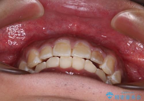 上顎前突とディープバイト ワイヤー矯正での確実に仕上げるの治療後