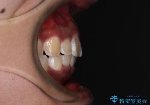 上顎前突とディープバイト ワイヤー矯正での確実に仕上げるの治療後