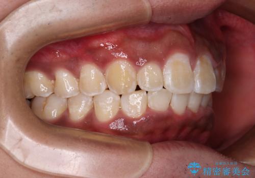 上顎前突とディープバイト ワイヤー矯正での確実に仕上げるの治療後