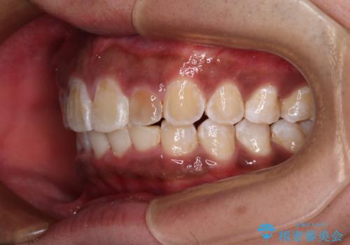 上顎前突とディープバイト ワイヤー矯正での確実に仕上げるの治療後