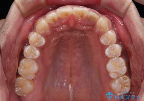 上顎前突とディープバイト ワイヤー矯正での確実に仕上げるの治療後