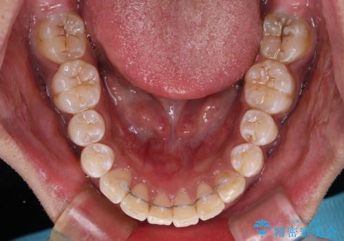 上顎前突とディープバイト ワイヤー矯正での確実に仕上げるの治療後