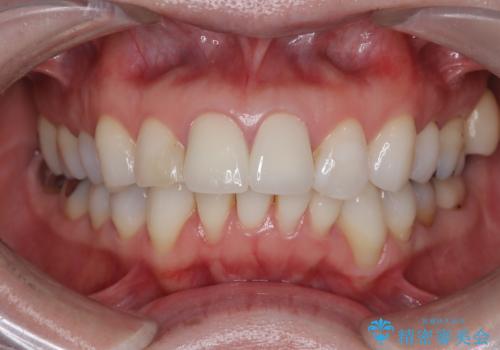 【オールセラミッククラウン】前歯の色が気になる!の治療後