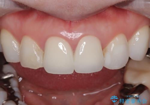 【オールセラミッククラウン】前歯の色が気になる!の治療後