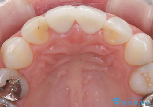 【オールセラミッククラウン】前歯の色が気になる!の治療後