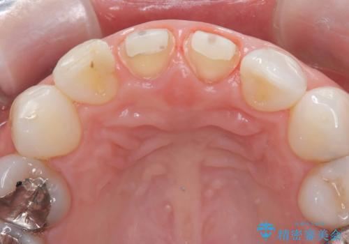 【オールセラミッククラウン】前歯の色が気になる!の治療中