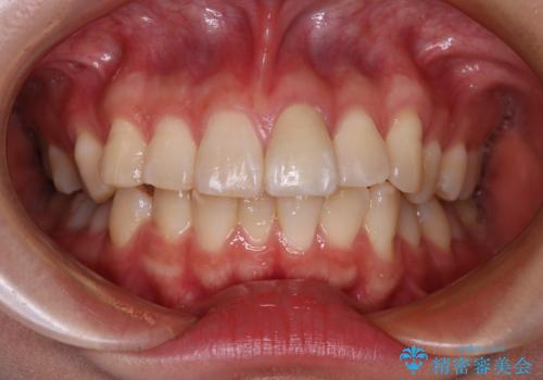 変色した前歯の詰め物 オールセラミッククラウンで本物の前歯のようにの治療後